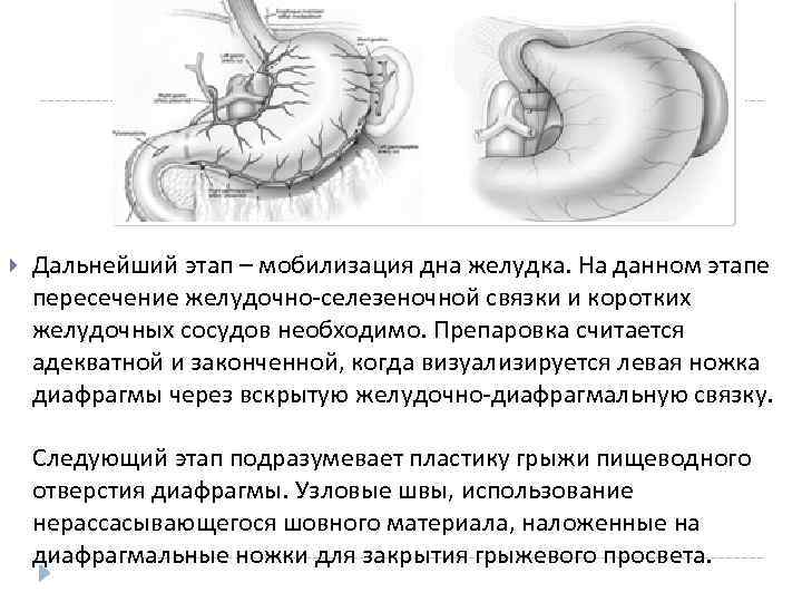  Дальнейший этап – мобилизация дна желудка. На данном этапе пересечение желудочно-селезеночной связки и