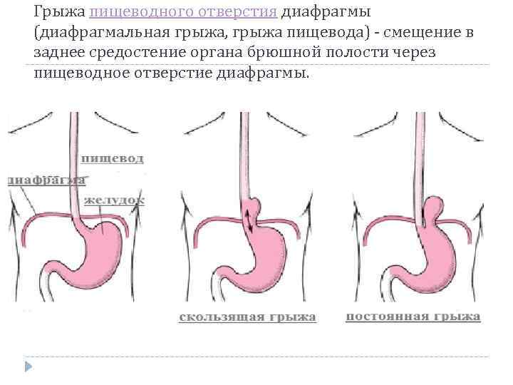 Грыжа пищеводного отверстия диафрагмы (диафрагмальная грыжа, грыжа пищевода) - смещение в заднее средостение органа