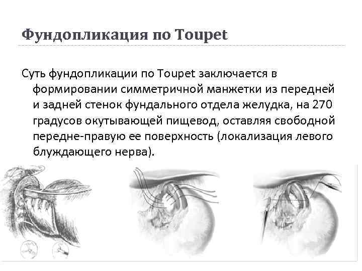 Фундопликация по Toupet Суть фундопликации по Toupet заключается в формировании симметричной манжетки из передней