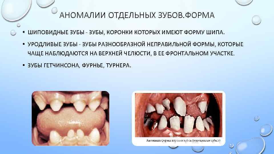 АНОМАЛИИ ОТДЕЛЬНЫХ ЗУБОВ. ФОРМА • ШИПОВИДНЫЕ ЗУБЫ - ЗУБЫ, КОРОНКИ КОТОРЫХ ИМЕЮТ ФОРМУ ШИПА.