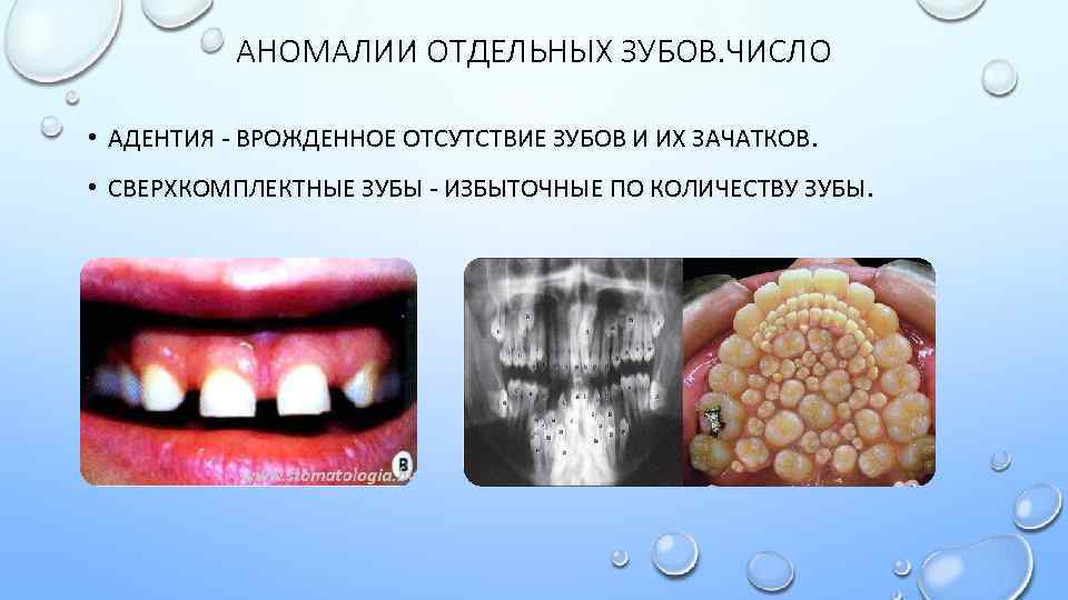 АНОМАЛИИ ОТДЕЛЬНЫХ ЗУБОВ. ЧИСЛО • АДЕНТИЯ - ВРОЖДЕННОЕ ОТСУТСТВИЕ ЗУБОВ И ИХ ЗАЧАТКОВ. •