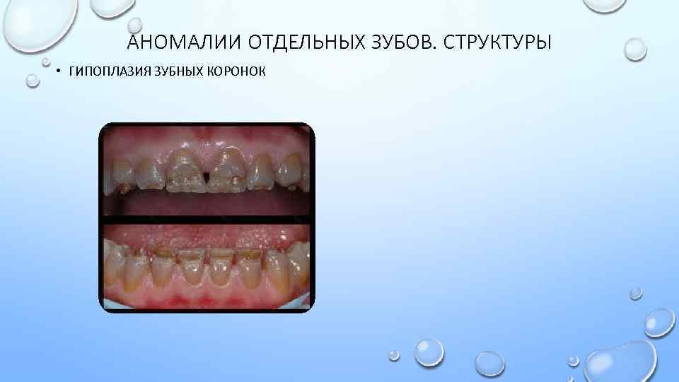 АНОМАЛИИ ОТДЕЛЬНЫХ ЗУБОВ. СТРУКТУРЫ • ГИПОПЛАЗИЯ ЗУБНЫХ КОРОНОК 