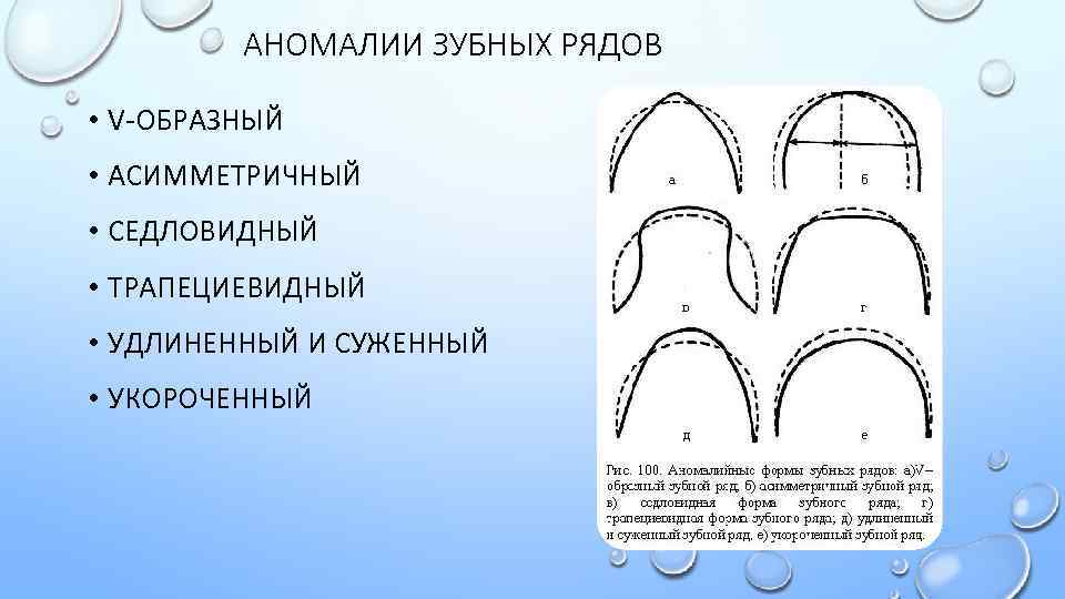 Вне дуги. Зубочелюстные аномалии (дефекты зубного ряда). Нарушение формы зубного ряда. Остроугольная форма зубных рядов. Седловидная форма верхней челюсти.