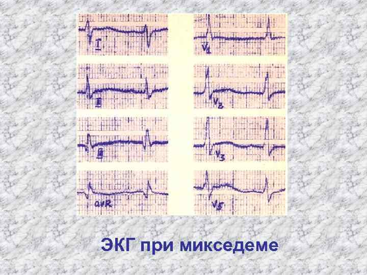 ЭКГ при микседеме 