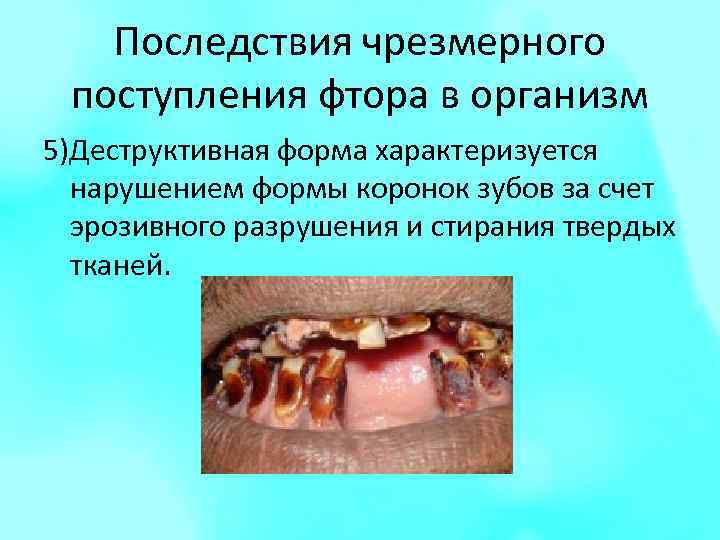 Последствия чрезмерного поступления фтора в организм 5)Деструктивная форма характеризуется нарушением формы коронок зубов за