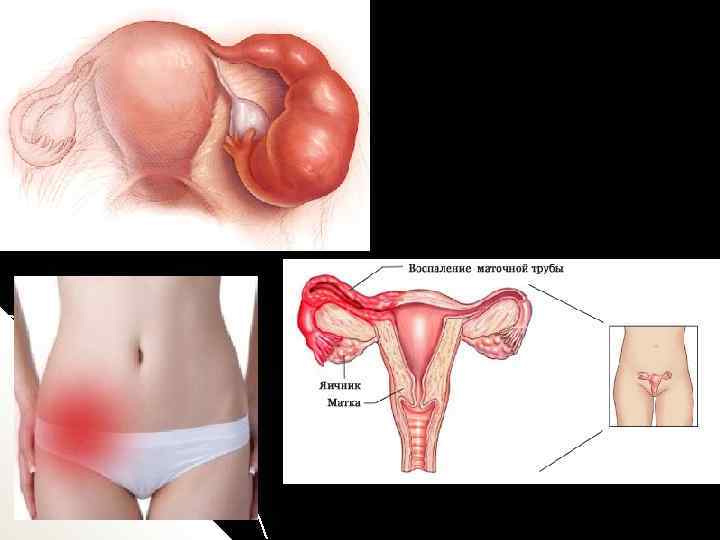 Воспаление матки у женщин симптомы и лечение. Воспаление трубы и яичника. Воспаление маточных труб. Маточныеттрубы воспаление.