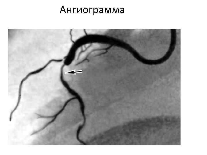 Ангиограмма 