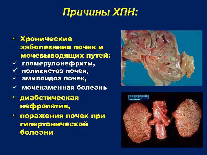 Причины ХПН: • Хронические заболевания почек и мочевыводящих путей: ü ü гломерулонефриты, поликистоз почек,