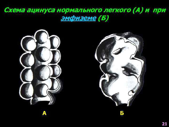 Схема ацинуса нормального легкого (А) и при эмфиземе (Б) А Б 21 