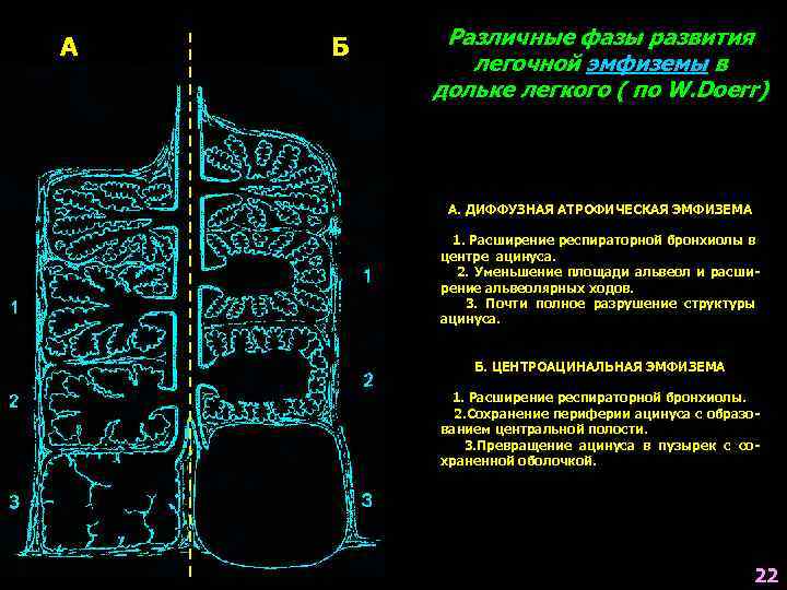 А Б Различные фазы развития легочной эмфиземы в дольке легкого ( по W. Doerr)