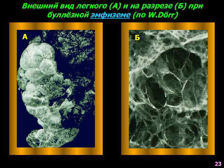 Внешний вид легкого (А) и на разрезе (Б) при буллёзной эмфиземе (по W. Dörr)
