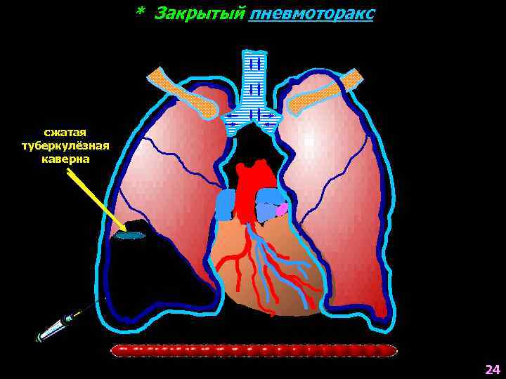 * Закрытый пневмоторакс сжатая туберкулёзная каверна, которую каверна необходимо сжать воздух 24 