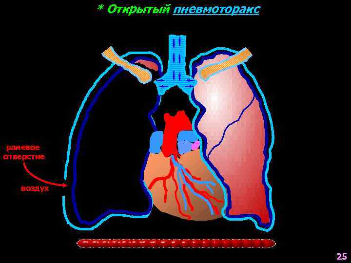 * Открытый пневмоторакс раневое отверстие воздух 25 