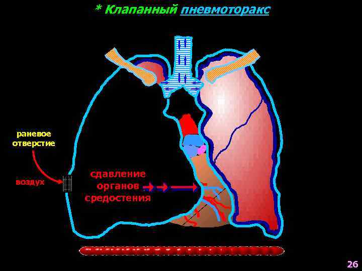 * Клапанный пневмоторакс раневое отверстие воздух сдавление органов средостения 26 