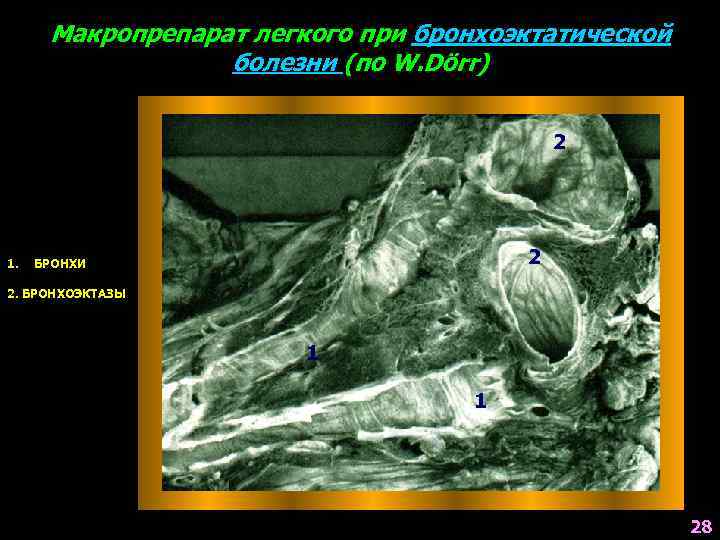 Макропрепарат легкого при бронхоэктатической болезни (по W. Dörr) 2 1. 2 БРОНХИ 2. БРОНХОЭКТАЗЫ