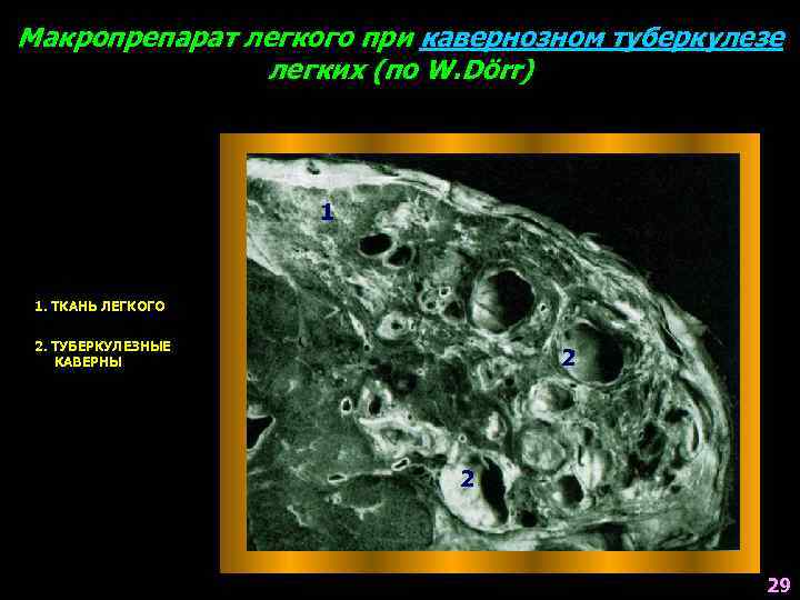 Макропрепарат легкого при кавернозном туберкулезе легких (по W. Dörr) 1 1. ТКАНЬ ЛЕГКОГО 2.