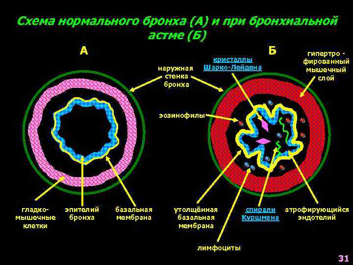 Схема нормального бронха (А) и при бронхиальной астме (Б) А наружная стенка бронха кристаллы