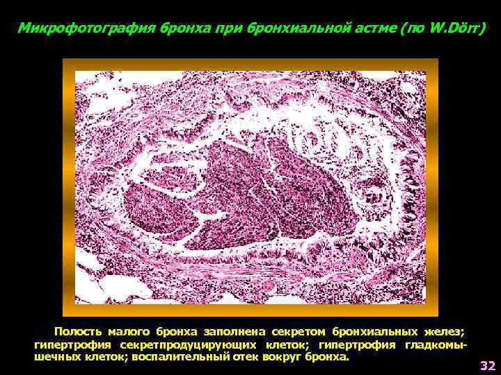 Микрофотография бронха при бронхиальной астме (по W. Dörr) Полость малого бронха заполнена секретом бронхиальных