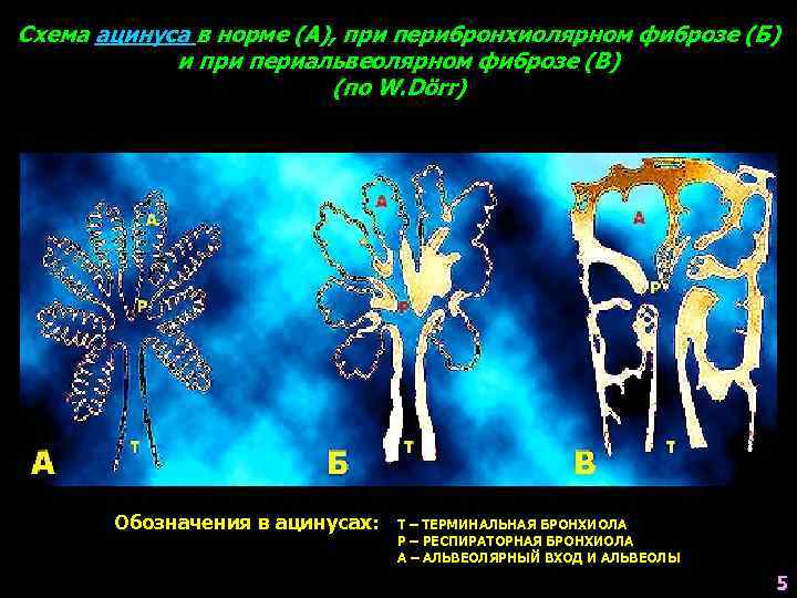 Схема ацинуса в норме (А), при перибронхиолярном фиброзе (Б) и при периальвеолярном фиброзе (В)