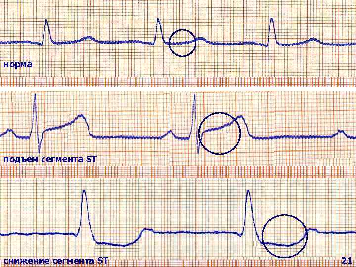 * Схема смещения сегмента ST относительно изоэлектрической линии при тотальной стенокардии. R T P