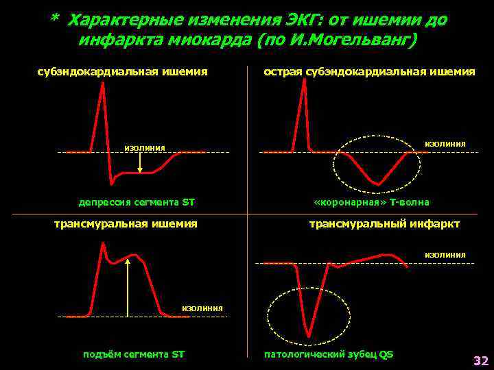 * Характерные изменения ЭКГ: от ишемии до инфаркта миокарда (по И. Могельванг) субэндокардиальная ишемия
