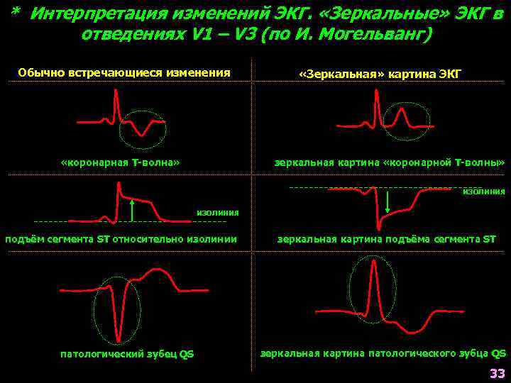 * Интерпретация изменений ЭКГ. «Зеркальные» ЭКГ в отведениях V 1 – V 3 (по