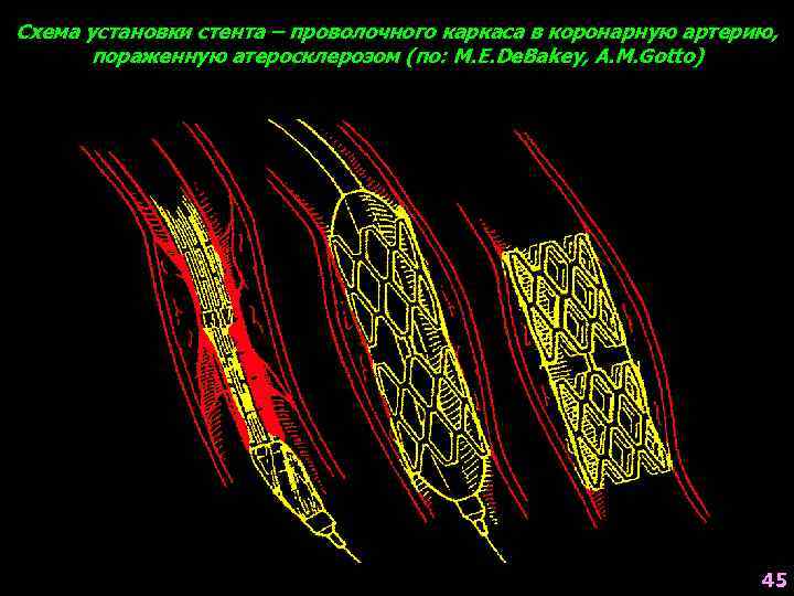 Схема установки стента – проволочного каркаса в коронарную артерию, пораженную атеросклерозом (по: M. E.