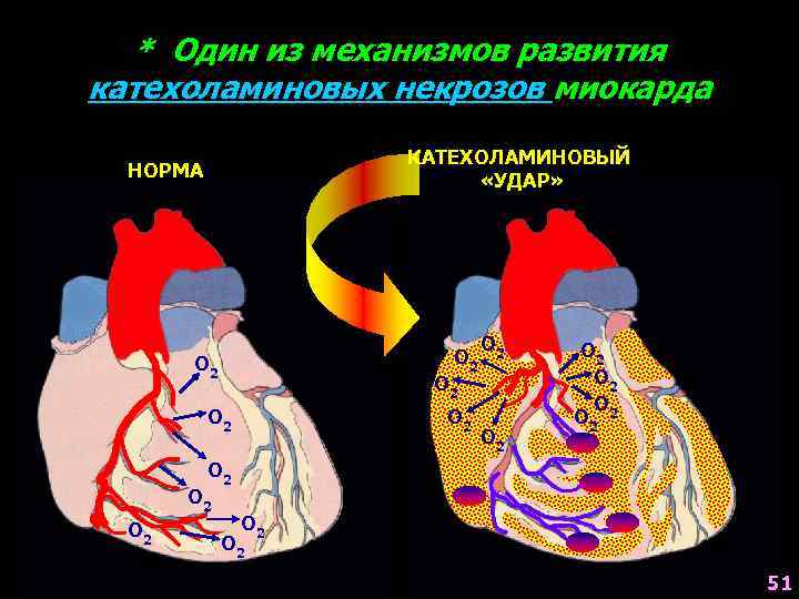 * Один из механизмов развития катехоламиновых некрозов миокарда КАТЕХОЛАМИНОВЫЙ «УДАР» НОРМА О 2 О