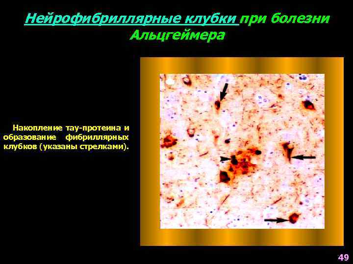 Нейрофибриллярные клубки при болезни Альцгеймера Накопление тау-протеина и образование фибриллярных клубков (указаны стрелками). 49