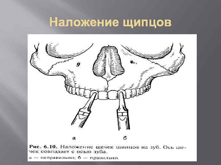 Наложение щипцов 