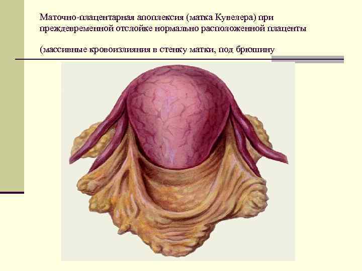 Маточно-плацентарная апоплексия (матка Кувелера) при преждевременной отслойке нормально расположенной плаценты (массивные кровоизлияния в стенку