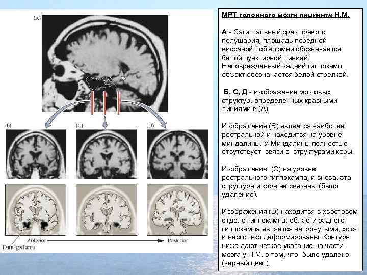 МРТ головного мозга пациента H. M. А - Сагиттальный срез правого полушария, площадь передней