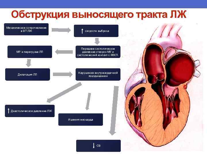 Дилатация полостей сердца