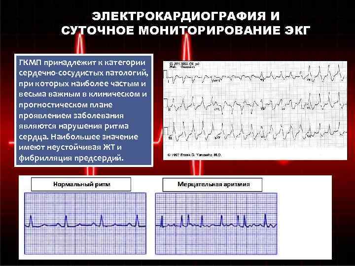 ЭЛЕКТРОКАРДИОГРАФИЯ И СУТОЧНОЕ МОНИТОРИРОВАНИЕ ЭКГ ГКМП принадлежит к категории сердечно-сосудистых патологий, при которых наиболее