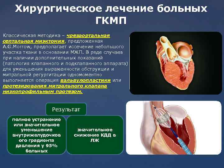 Хирургическое лечение больных ГКМП Классическая методика – чрезаортальная септальная миэктомия, предложенная A. G. Morrow,