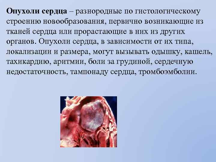Опухоли сердца – разнородные по гистологическому строению новообразования, первично возникающие из тканей сердца или