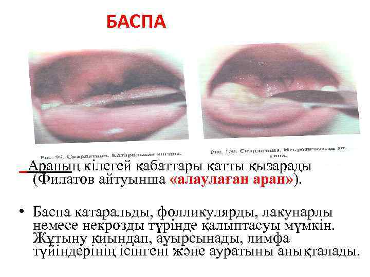 БАСПА Араның кілегей қабаттары қатты қызарады (Филатов айтуынша «алаулаған аран» ). • Баспа катаральды,