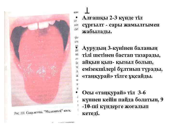 Т • Алғашқы 2 -3 күнде тіл сұрғылт - сары жамылғымен жабылады. • Аурудың