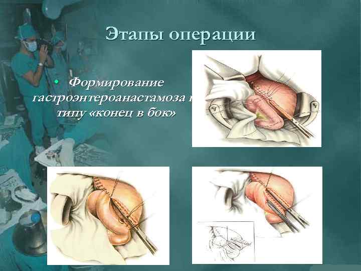 Этапы операции • Формирование гастроэнтероанастамоза по типу «конец в бок» 