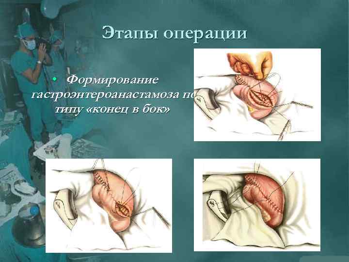 Этапы операции • Формирование гастроэнтероанастамоза по типу «конец в бок» 