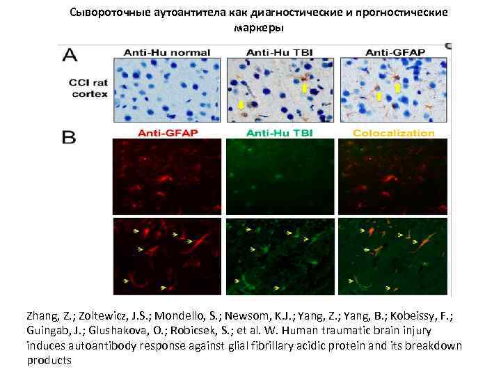 Сывороточные аутоантитела как диагностические и прогностические маркеры Zhang, Z. ; Zoltewicz, J. S. ;