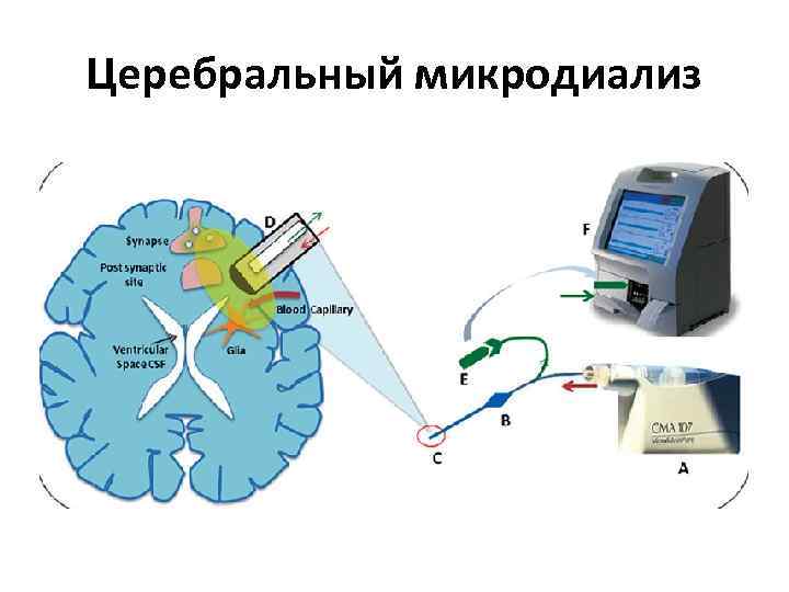 Церебральный микродиализ 