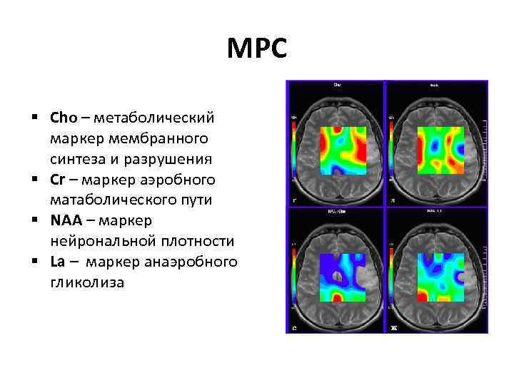 МРС § Cho – метаболический маркер мембранного синтеза и разрушения § Cr – маркер