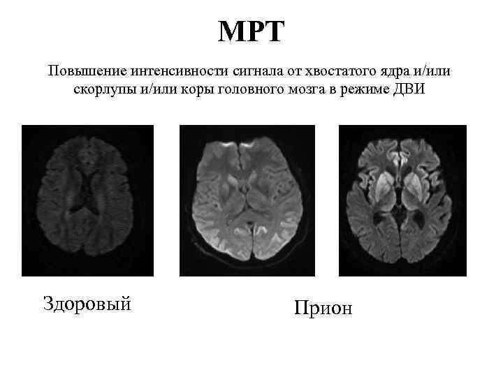 МРТ Повышение интенсивности сигнала от хвостатого ядра и/или скорлупы и/или коры головного мозга в