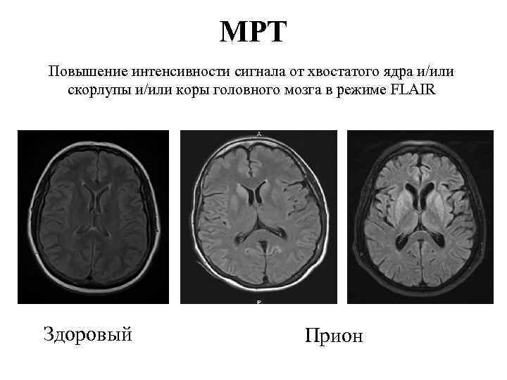 МРТ Повышение интенсивности сигнала от хвостатого ядра и/или скорлупы и/или коры головного мозга в