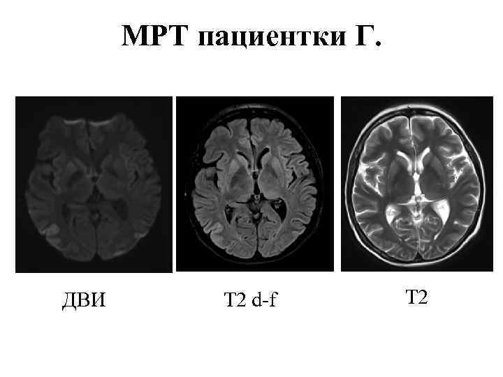 МРТ пациентки Г. ДВИ T 2 d-f T 2 