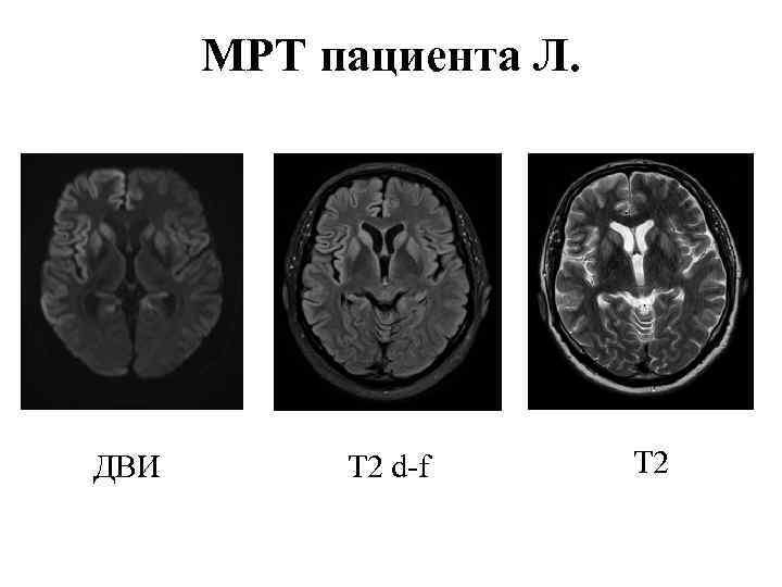 МРТ пациента Л. ДВИ T 2 d-f T 2 