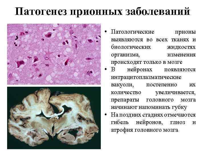 Патогенез прионных заболеваний • Патологические прионы выявляются во всех тканях и биологических жидкостях организма,