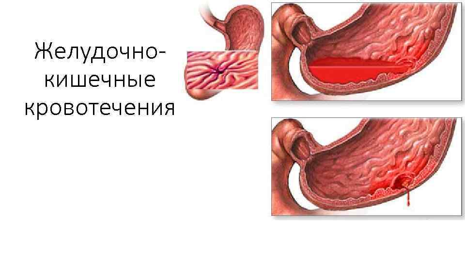 Желудочнокишечные кровотечения 