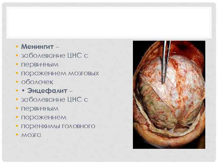  • • • Менингит – заболевание ЦНС с первичным поражением мозговых оболочек •